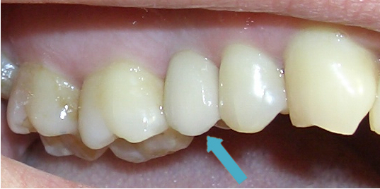 Ersatz der Zahnkrone 15 auf einem Zahnimplantat