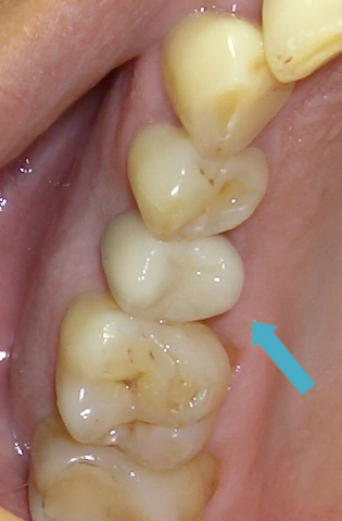 Ersatz der Zahnkrone 15 auf einem Zahnimplantat
