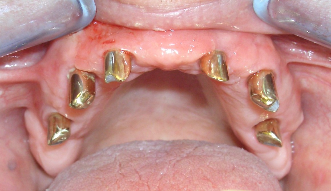 Prothese auf Zahnimplantaten im Oberkiefer mit reduzierter Abdeckung des Gaumens