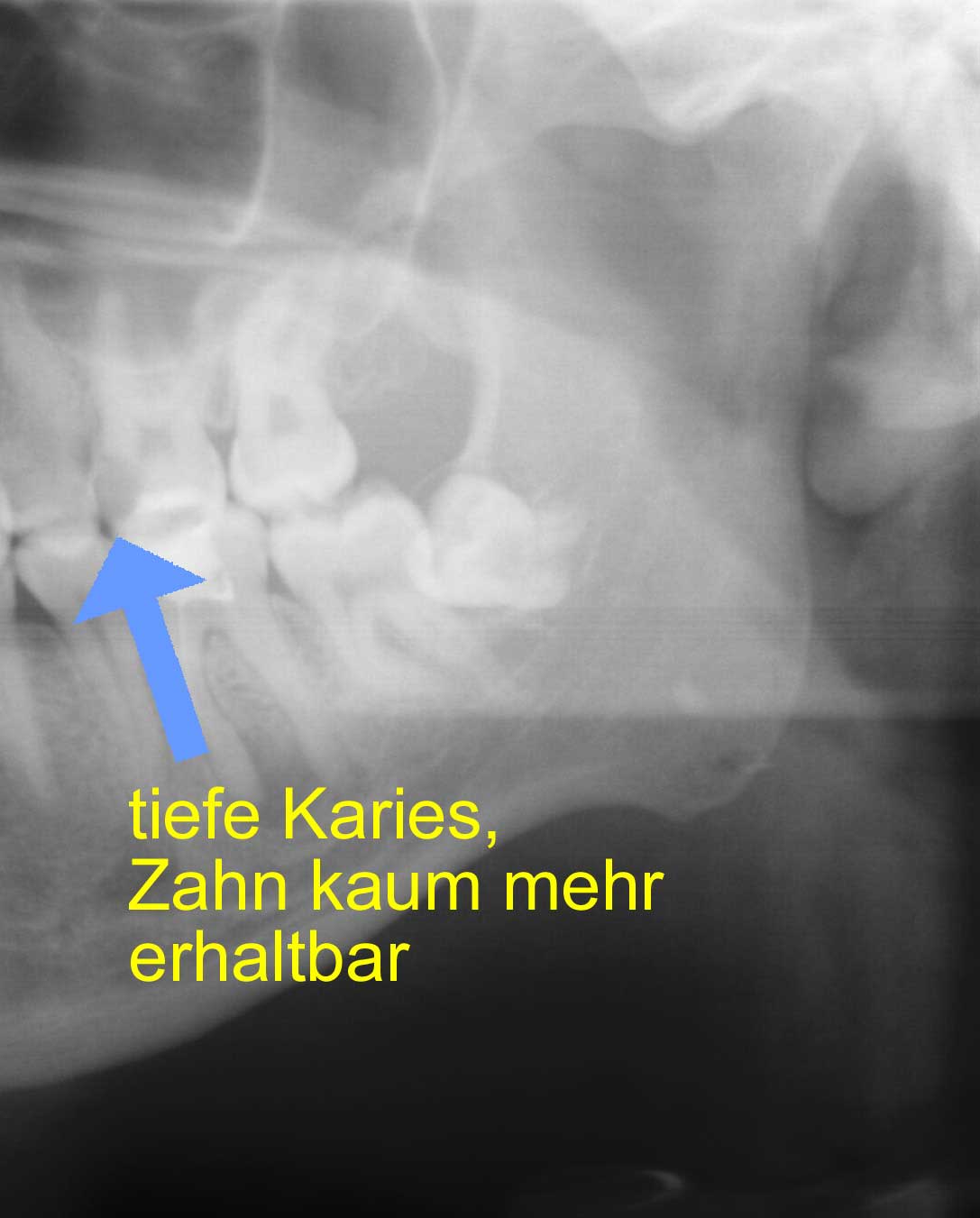 nicht erhaltbarer Zahn im Röntgenbild